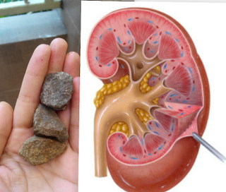 Illustration for article titled obat batu ginjal terbaik